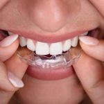 Invisalign and Clear Aligners for Teens and Adults Pros, Cons & Benefits