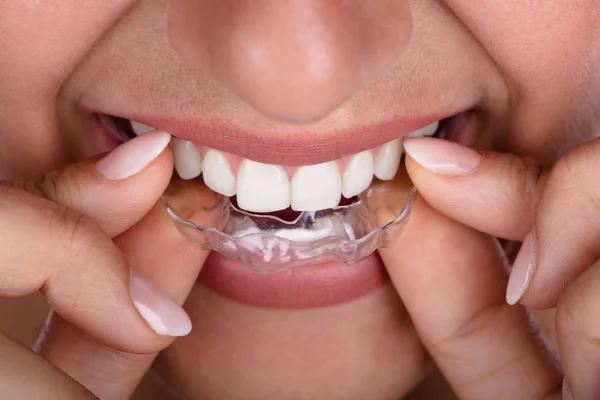 Invisalign and Clear Aligners for Teens and Adults Pros, Cons & Benefits