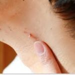 Mole Removal Cosmetic Clinics Guide